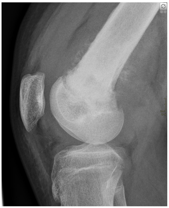 Afbeelding met röntgenfilm, röntgenfoto, radiografie, radiologie
Door AI gegenereerde inhoud is mogelijk onjuist.