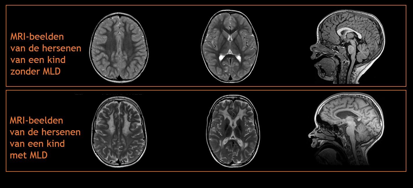 MRI hersenen