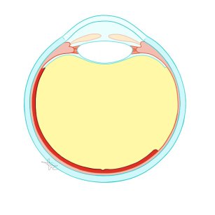 Gecompliceerde netvliesloslating 5