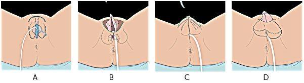 Het creëren van balzak bij metaïdoioplastiek plasbuisverlenging, Afbeelding