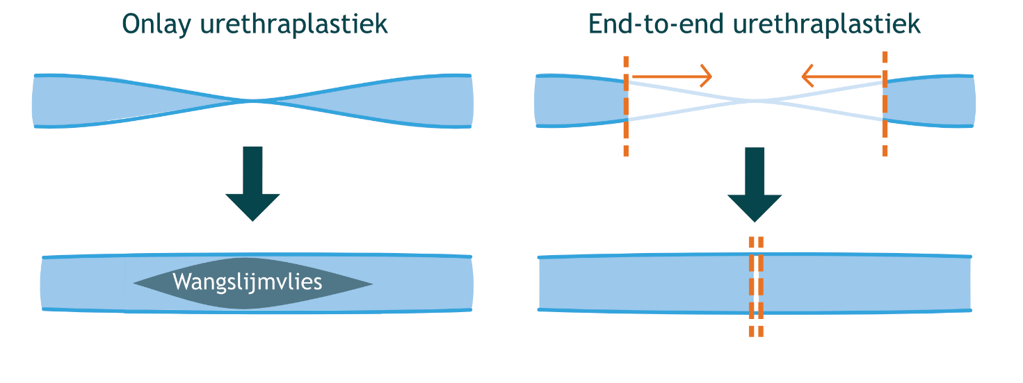 Plasbuisvernauwing urethrastrictuur Diagnostiek Behandelingen plasbuisvernauwing-urethrastrictuur-diagnostiek-behandelingen