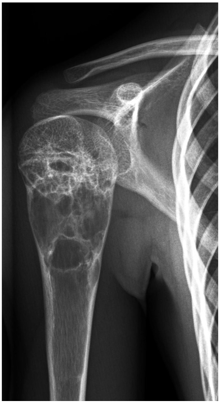 Afbeelding met röntgenfilm, Medische beeldbewerking, radiologie, röntgenfoto
Door AI gegenereerde inhoud is mogelijk onjuist.
