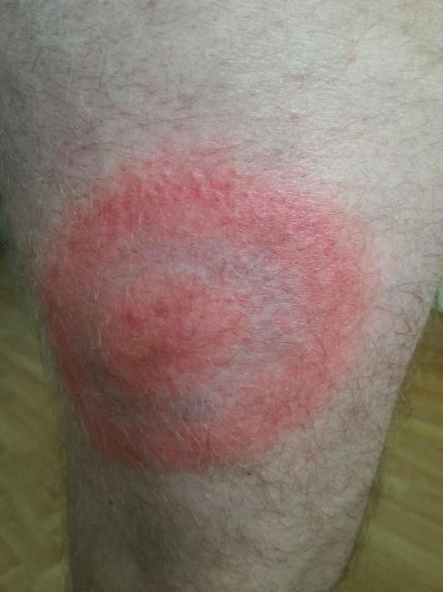 Lyme Borreliose Lyme Borreliose Heilbar LHMRAH Lyme Borreliose Lyme Borreliose Heilbar LHMRAH