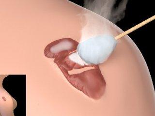 Cryotherapie; het bevriezen van een litteken