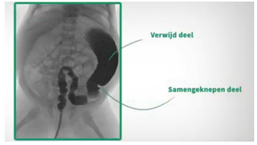 Ziekte van Hirschsprung
