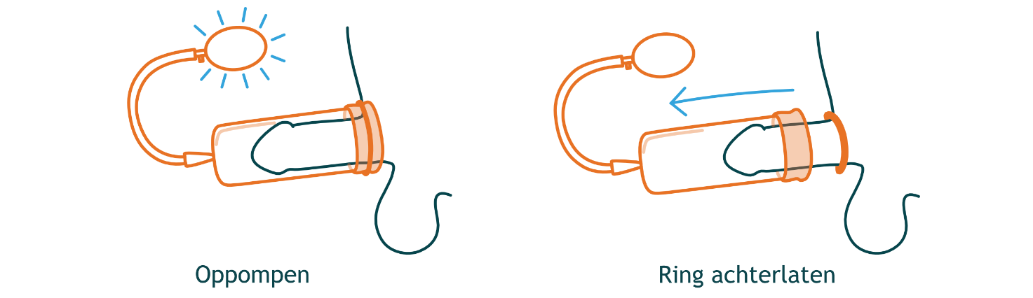 Penispomp: leer hoe het uw prestaties kan helpen