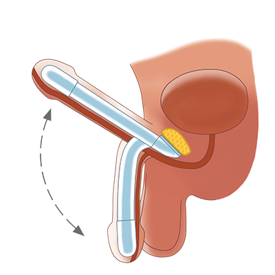 Bron: Zephyr Surgical Implants (ZSI)
