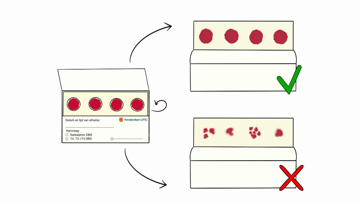 Instruction collecting blood spots at home (Engelse versie) | Amsterdam UMC