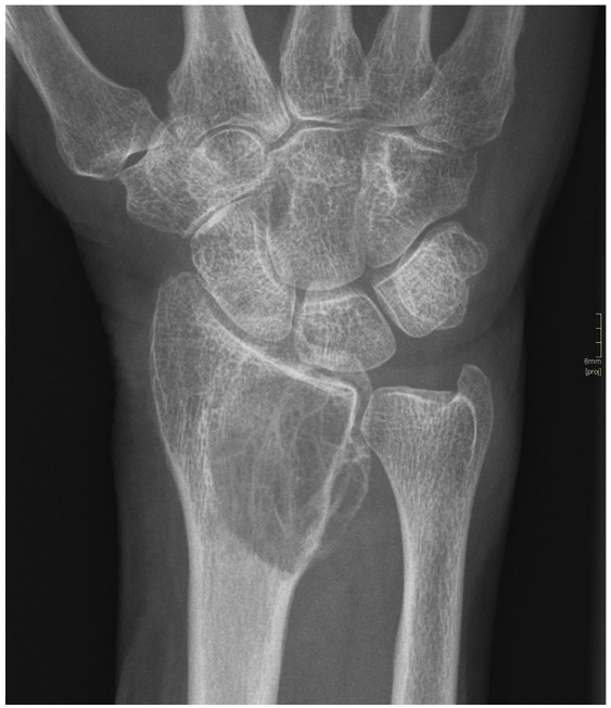 Afbeelding met röntgenfilm, Medische beeldbewerking, radiografie, radiologie
Door AI gegenereerde inhoud is mogelijk onjuist.