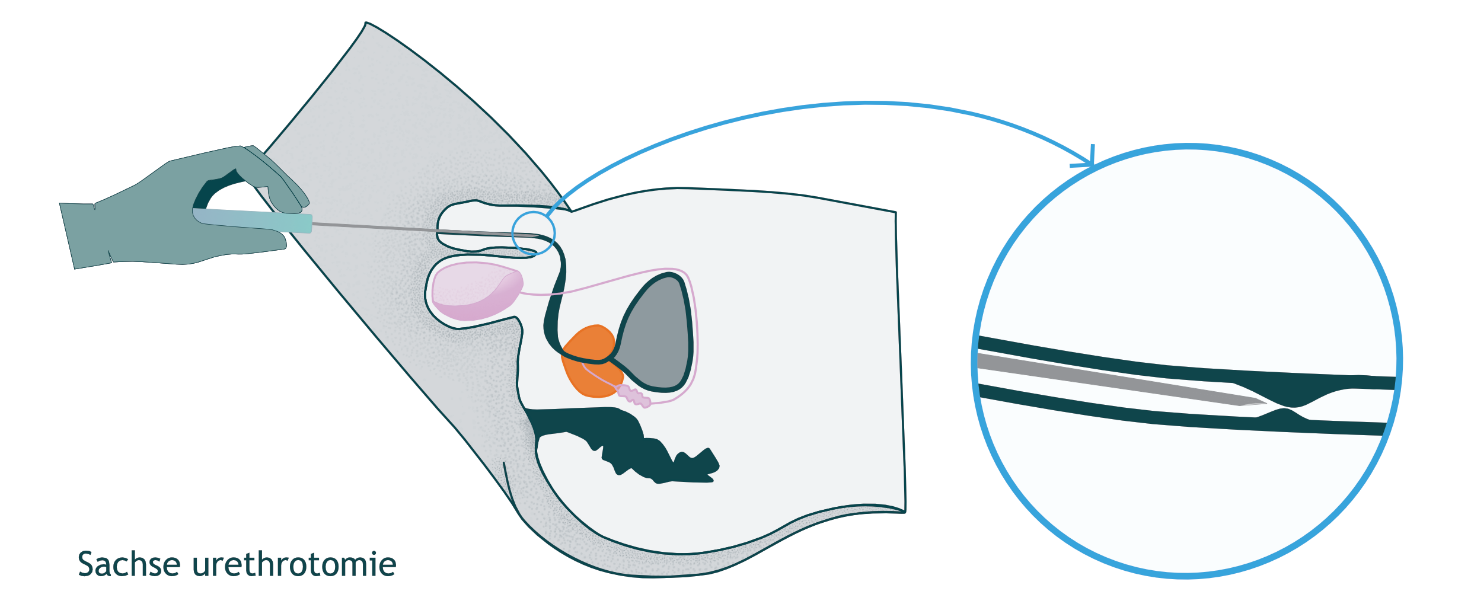 Plasbuisvernauwing urethrastrictuur Diagnostiek Behandelingen plasbuisvernauwing-urethrastrictuur-diagnostiek-behandelingen