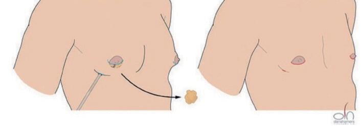 Keyhole techniek, Afbeelding