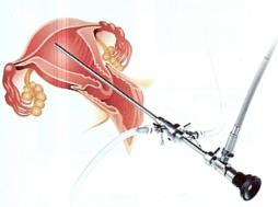 http://www.ch-belvedere.fr/chirurgie/chir_gyn/hysteroscopie/hysteroscopie2.jpg