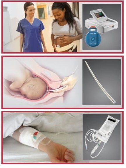 De verschillende fases van het inleiden van een bevalling