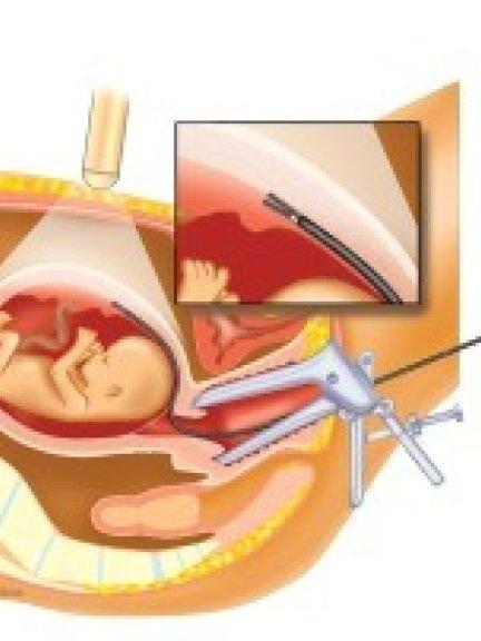 vlokkentest via de vagina