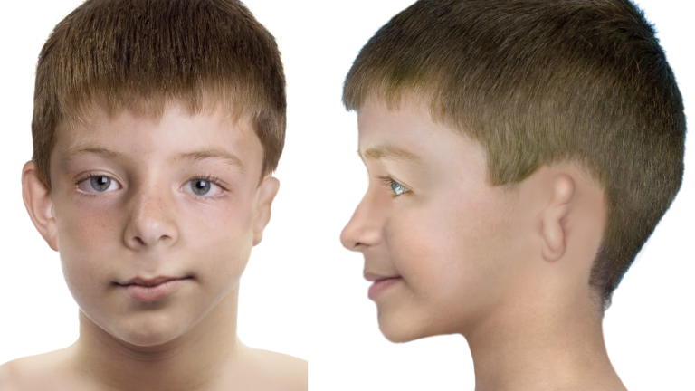 samengesteld kind 12 jaar craniofaciale microsomie - en face - en profil