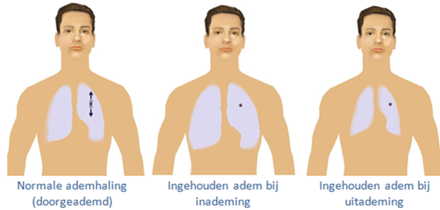 Bestraling met ingehouden adem (Breath Hold) | Amsterdam UMC
