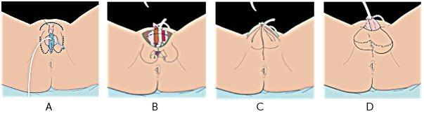 Het creëren van balzak bij metaïdoioplastiek met plasbuisverlenging, Afbeelding