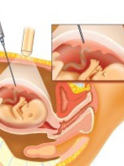 vlokkentest via de buikwand