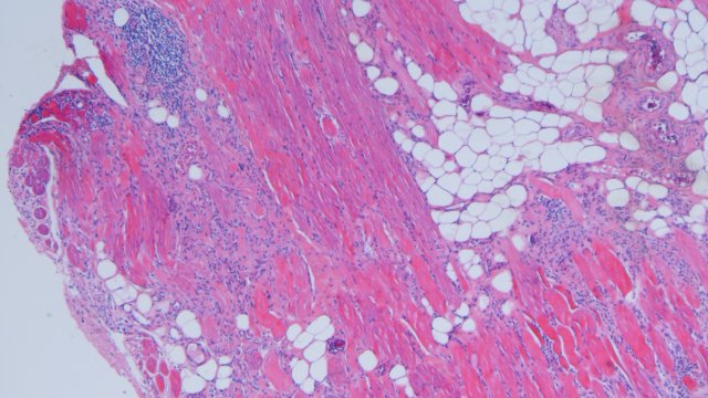 De donkerblauwe stippen zijn ontstekingscellen. De roze structuren zijn spiervezels. Ter plaatse van de witte bollen heeft het spierweefsel plaatsgemaakt voor vetweefsel.