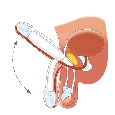 Bron: Zephyr Surgical Implants (ZSI)