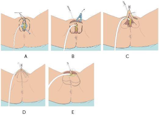Het maken van de balzak bij phalloplastiek met plasbuisverlenging, Afbeelding