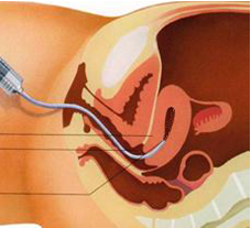 embryoplaatsing