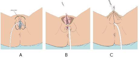 Het maken van de balzak bij phalloplastiek zonder plasbuisverlenging, Afbeelding